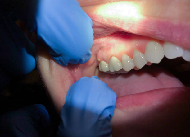 Best Urgent Care for Lost Fillings or Crowns in Royalton, MN